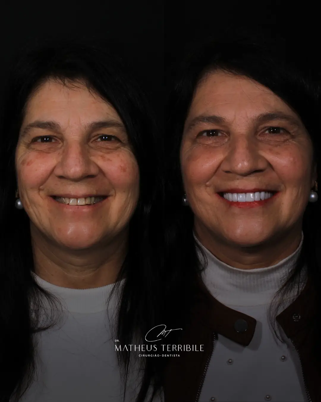 Antes e depois do rosto de uma paciente, à esquerda sem as lentes em porcelana e à direita com as lentes