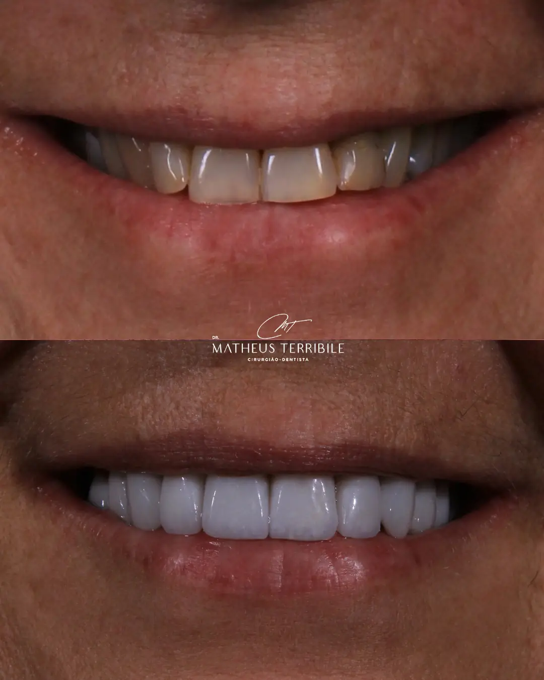 Antes e depois do sorriso da mesma paciente, em aproximação, com as lentes em porcelana na imagem de baixo