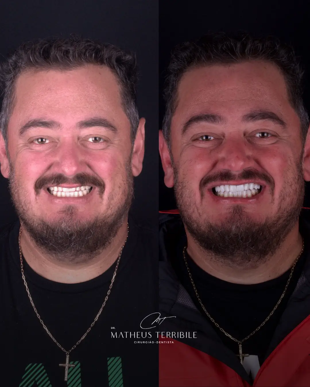 Antes e depois do rosto de um paciente, à esquerda sem as lentes em porcelana e à direita com as lentes