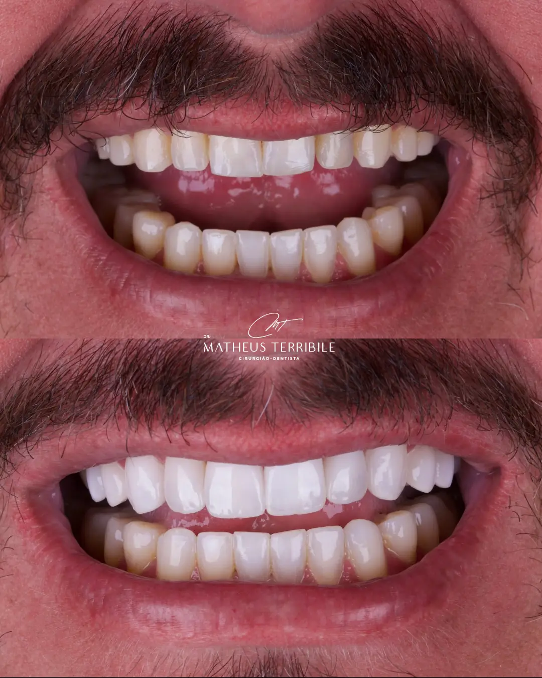 Antes e depois do sorriso do mesmo paciente, em aproximação, com as lentes em porcelana na imagem de baixo