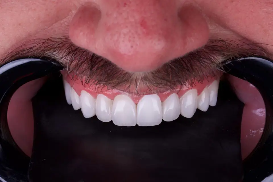 Sorriso de paciente com lentes em porcelana, em aproximação, com afastador